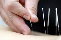 Stire din Sănătate : Acupunctura tratează durerile de orice fel