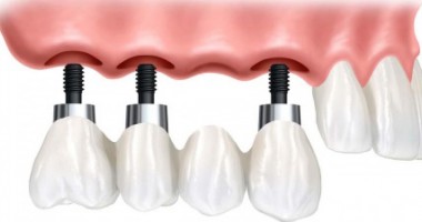 Stire din Cetățenești : Când se recomandă implant dentar?