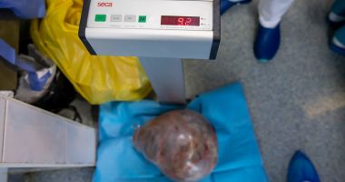 Atenţie, IMAGINI CU IMPACT EMOŢIONAL! Chist de aproape 10 kilograme, extras din abdomenul unei femei - 2