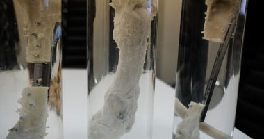 Stire din Sănătate : Fragment de os dezvoltat în laborator, implantat cu succes în tibia fracturată a unui bărbat
