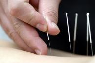 Stire din Sănătate : Constănțenii pot face acupunctură pe banii statului