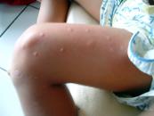 Stire din Sănătate : Înțepăturile de insecte trebuie tratate cu maximă atenție