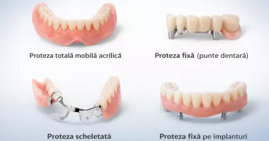 Tipuri de proteze dentare: care este soluția potrivită pentru tine?