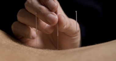 Stire din Sănătate : Cum ne vindecăm prin acupunctură și terapia "focului viu"