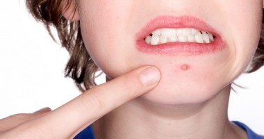 Stire din Sănătate : Adolescenții cu acnee din Constanța, implicați într-o campanie națională