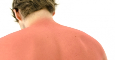 Stire din Sănătate : Efectele devastatoare ale arsurilor solare