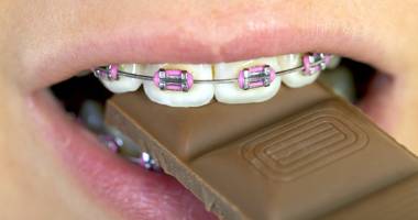 Stire din Sănătate : Alimente interzise! Nu le consumați dacă purtați aparat dentar