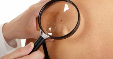Stire din Sănătate : Când ar trebui să ne îngrijoreze alunițele de pe piele
