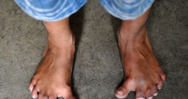 Un băiat din India are 25 de degete / Galerie foto - 2