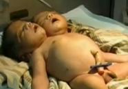 Video | Bebeluș cu două capete născut în India