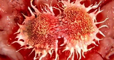 Stire din Sănătate : Cancerul trebuie privit ca o boală cronică!