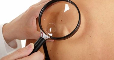 Stire din Sănătate : De patru ori mai mulți pacienți cu cancer de piele