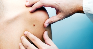 Stire din Sănătate : Pericolul expunerii la soare! Favorizează apariția cancerului de piele