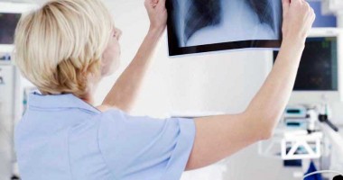 Stire din Sănătate : Cum ucide cancerul pulmonar