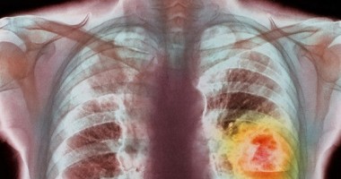 Stire din Sănătate : Primăria Cumpăna demarează o campanie de depistare a cancerului pulmonar și accidentelor vasculare ischiemice
