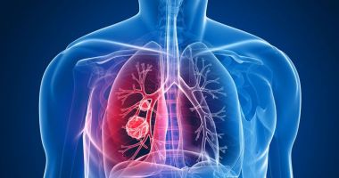 Stire din Actualitate : Creşterea cazurilor de cancer pulmonar la nefumători, legată de un gaz radioactiv din aer