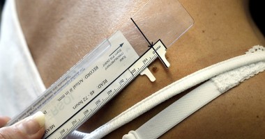 Stire din Sănătate : Când devin alunițele un pericol pentru sănătate