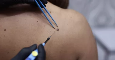 Stire din Sănătate : Cauterizarea negilor - soluția rapidă pentru eliminarea verucilor rezistente