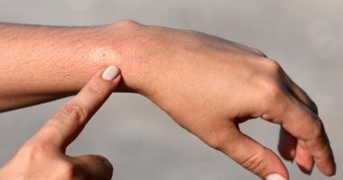 Primul ajutor. Ce faci dacă te-a înţepat o albină