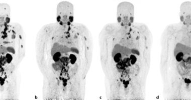 Stire din Sănătate : Celulele canceroase ar putea fi distruse cu ajutorul unei tehnologii dezvoltate la Centrala Nucleară de la Cernavodă