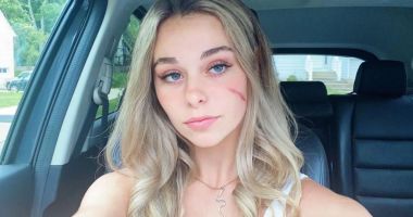 Stire din Sănătate : Cicatricile se formează după ce o rană este complet vindecată