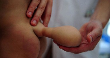 Atenție, IMAGINI ȘOCANTE! Cazul cutremurător al copilului născut cu o coadă care tot crește! - 3