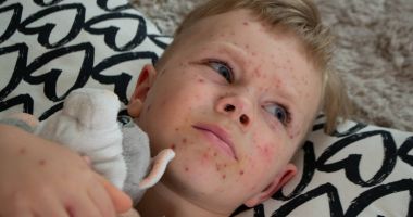 Stire din Sănătate : Cât de periculoasă este ruperea cojilor în bolile infecțioase