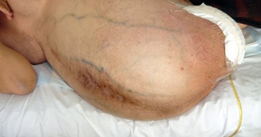 Coșmarul unui constănțean: operat a doua oară de o formă rară de cancer! - 2