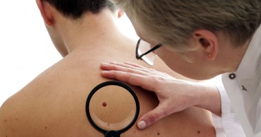 Stire din Sănătate : Cum vor fi prescrise medicamentele pentru bolnavii de psoriazis