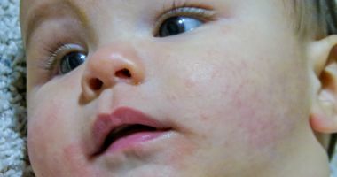 Dermatita atopică apare cel mai des la copii