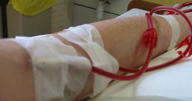 Stire din Sănătate : Metodă nouă de dializă, inventată de medicii români