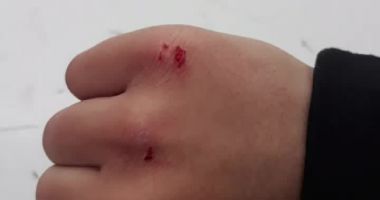 ATENŢIE, IMAGINI CU IMPACT EMOŢIONAL! "Moneda rusească", joc periculos printre elevi. Medic: "Infecția poate să ajungă la nivelul oaselor" - 2