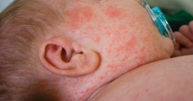 Stire din Sănătate : Epidemie de rujeolă!  Au murit deja șase persoane