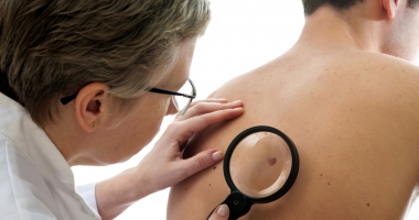 Stire din Sănătate : Care sunt principalii factori ce pot cauza cancer de piele