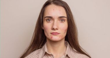 Stire din Sănătate : Acneea la adolescenți: de ce tratamentele găsite pe rețelele sociale pot fi periculoase