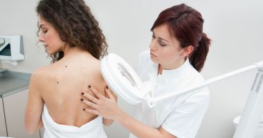 Stire din Sănătate : Alunițe prea multe? Feriți-le pe cât puteți de razele solare!