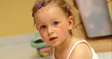 Stire din Sănătate : Dermatita atopică la copii. Greșelile care agravează boala fără să îți dai seama