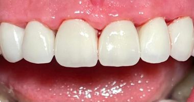 Fațetele dentare, o soluție în estetica modernă, la M&M Dental Team - 3