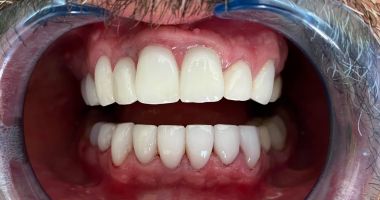 Fațetele dentare, o soluție în estetica modernă, la M&M Dental Team - 4