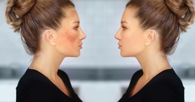 Stire din Sănătate : Melasma - secretul pentru un ten uniform și fără pete