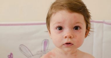 Roseola infantum este o boală infecţioasă, asemănătoare rujeolei