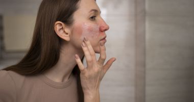 Stire din Sănătate : Rozaceea, afecțiunea ale cărei simptome pot fi ținute sub control