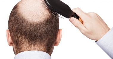 Stire din Sănătate : Cum poate fi stopată căderea părului. "Nu există un tratament standard pentru alopecie"