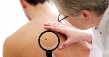Stire din Sănătate : Analiza care diagnostichează cu precizie cancerul de piele