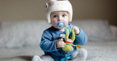 Stire din Sănătate : Craniosinostoza - afecțiunea care duce la deformări craniene ale bebelușilor