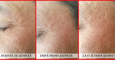 Stire din Sănătate : Bucură-te de beneficiile toxinei botulinice, fără a apela la Botox!