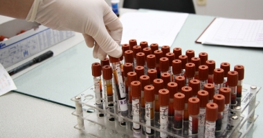 Stire din Sănătate : Testul Imunopro 300, una dintre cele mai precise metode de diagnostic