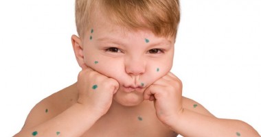 Stire din Sănătate : Atenție: Vărsatul de vânt nu-i afectează doar pe copii!