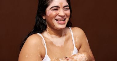 Nu vă speriaţi! Vitiligo nu este o boală contagioasă