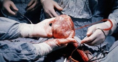 Stire din Sănătate : Programul de transplant cardiac, reluat anul acesta